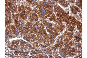 IHC-P Image Immunohistochemical analysis of paraffin-embedded human hepatoma, using mtRNA polymerase, antibody at 1:500 dilution. (POLRMT 抗体  (Center))