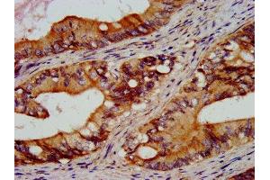 IHC image of ABIN7167616 diluted at 1:300 and staining in paraffin-embedded human colon cancer performed on a Leica BondTM system. (RGS6 抗体  (AA 177-262))