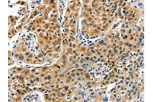 The image on the left is immunohistochemistry of paraffin-embedded Human lung cancer tissue using ABIN7191847(PFDN6 Antibody) at dilution 1/35, on the right is treated with synthetic peptide. (PFDN6 抗体)
