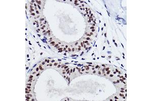 Immunohistochemistry of paraffin-embedded human breast cancer using SNRP Rabbit mAb (ABIN7270365) at dilution of 1:100 (40x lens). (SNRPA1 抗体)