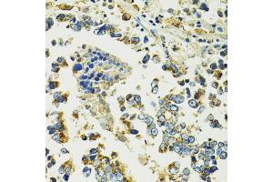 Immunohistochemistry of paraffin-embedded human colon carcinoma using SLC25 antibody (ABIN6132660, ABIN6147903, ABIN6147904 and ABIN6224187) at dilution of 1:100 (40x lens). (SLC25A11 抗体  (AA 1-314))