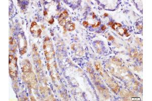 Formalin-fixed and paraffin embedded human gastric carcinoma labeled with Rabbit Anti-EDA2R Polyclonal Antibody, Unconjugated  at 1:200 followed by conjugation to the secondary antibody and DAB staining (Ectodysplasin A2 Receptor 抗体  (AA 51-150))