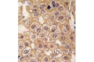 Formalin-fixed and paraffin-embedded human hepatocarcinoma tissue reacted with BAR2 Antibody , which was peroxidase-conjugated to the secondary antibody, followed by DAB staining.