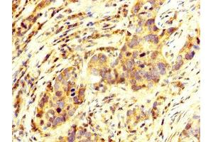 IHC image of ABIN7155839 diluted at 1:250 and staining in paraffin-embedded human pancreatic cancer performed on a Leica BondTM system. (OTX2 抗体  (AA 1-297))