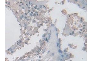 Detection of IDH2 in Human Prostate Tissue using Polyclonal Antibody to Isocitrate Dehydrogenase 2, mitochondrial (IDH2)