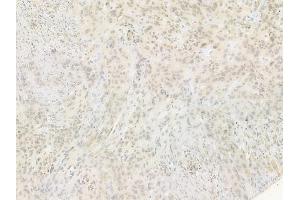 ABIN6255118 and ABIN6267547 at 1/100 staining human tongue carcinoma by IHC-P.