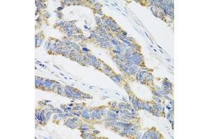 Immunohistochemistry of paraffin-embedded human colon carcinoma using CYP1A1 antibody (ABIN5971186) at dilution of 1/100 (40x lens). (CYP1A1 抗体)