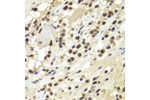 Immunohistochemistry of paraffin-embedded human kidney cancer using PRKDC antibody at dilution of 1:100 (x400 lens). (PRKDC 抗体)
