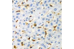Immunohistochemistry of paraffin-embedded human liver injury using CD68 antibody (ABIN5975414) at dilution of 1/100 (40x lens). (CD68 抗体)