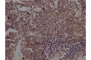 IHC image of ABIN7127369 diluted at 1:100 and staining in paraffin-embedded human lung cancer performed on a Leica BondTM system. (Recombinant BMI1 抗体)