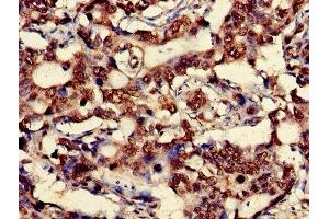 Immunohistochemistry of paraffin-embedded human gastric cancer using ABIN7149162 at dilution of 1:100 (COX IV 抗体  (Isoform 1))