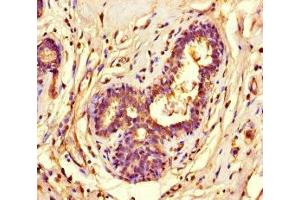 Immunohistochemistry of paraffin-embedded human breast cancer using ABIN7155525 at dilution of 1:100 (SUV39H1 抗体  (AA 179-412))