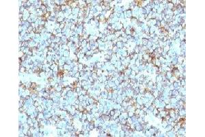 Formalin-fixed, paraffin-embedded human Ewing's sarcoma stained with CD99 antibody (MIC2/877). (CD99 抗体)