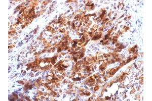 Formalin-fixed, paraffin-embedded human Hepatocellular Carcinoma stained with Glypican-3 Mouse Recombinant Monoclonal Ab (rGPC3/863). (Recombinant Glypican 3 抗体)