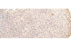 Immunohistochemistry of paraffin-embedded Human cervical cancer tissue using ZNF263 Polyclonal Antibody at dilution of 1:30(x200) (ZNF263 抗体)