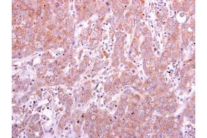 IHC-P Image PGD antibody detects PGD protein at cytoplasm on human breast carcinoma by immunohistochemical analysis. (PGD 抗体)