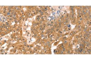 Immunohistochemistry of paraffin-embedded Human breast cancer using RPS6KA1 Polyclonal Antibody at dilution of 1:30 (RPS6KA1 抗体)
