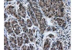 Immunohistochemical staining of paraffin-embedded Carcinoma of liver tissue using anti-HSPA1Amouse monoclonal antibody. (HSP70 1A 抗体)