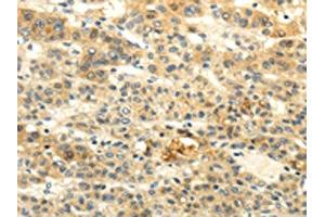 The image on the left is immunohistochemistry of paraffin-embedded Human liver cancer tissue using ABIN7190020(BRWD1 Antibody) at dilution 1/20, on the right is treated with synthetic peptide. (BRWD1 抗体)