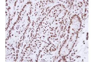 IHC-P Image Immunohistochemical analysis of paraffin-embedded A549 xenograft, using Progesterone receptor, antibody at 1:100 dilution. (Progesterone Receptor 抗体  (N-Term))