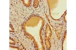 Immunohistochemistry of paraffin-embedded human prostate cancer using ABIN7148034 at dilution of 1:100 (CBWD2 抗体  (AA 96-395))