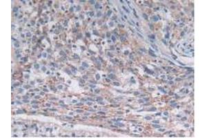 IHC-P analysis of Human Lung Cancer Tissue, with DAB staining. (SNX13 抗体  (AA 97-284))