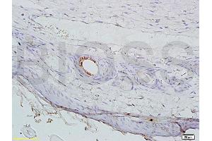 Formalin-fixed and paraffin embedded mouse cancer tissue labeled with Anti-AGPAT4 Polyclonal Antibody, Unconjugated (ABIN708671) at 1:200 followed by conjugation to the secondary antibody, (SP-0023), and DAB staining (AGPAT4 抗体  (AA 231-330))