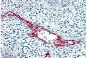 Human Uterus, Vessels (formalin-fixed, paraffin-embedded) stained with F8 antibody ABIN396921 at 10 ug/ml followed by biotinylated anti-mouse IgG secondary antibody ABIN481714, alkaline phosphatase-streptavidin and chromogen. (Factor VIII 抗体)