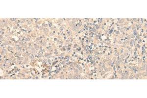 Immunohistochemistry of paraffin-embedded Human cervical cancer tissue using PNKD Polyclonal Antibody at dilution of 1:35(x200) (PNKD 抗体)
