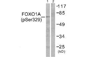 Immunohistochemistry analysis of paraffin-embedded human breast carcinoma tissue using FOXO1A (Phospho-Ser329) antibody. (FOXO1 抗体  (pSer329))