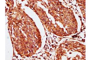 IHC image of ABIN7163536 diluted at 1:200 and staining in paraffin-embedded human cervical cancer performed on a Leica BondTM system. (SERPINB2 抗体  (AA 293-389))
