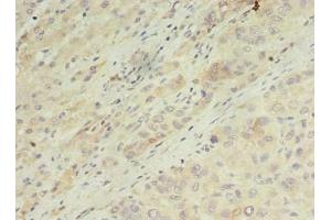 Immunohistochemistry of paraffin-embedded human liver cancer using ABIN7143481 at dilution of 1:100 (ARL14 抗体  (AA 2-192))