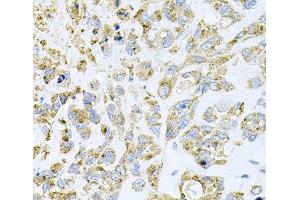 Immunohistochemistry of paraffin-embedded Human lung cancer using HDAC3 Polyclonal Antibody at dilution of 1:100 (40x lens). (HDAC3 抗体)