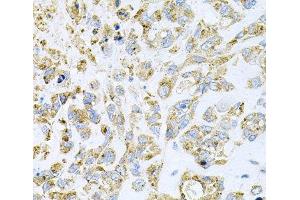 Immunohistochemistry of paraffin-embedded Human lung cancer using HDAC3 Polyclonal Antibody at dilution of 1:100 (40x lens).