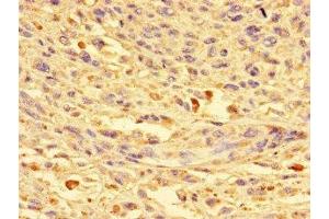 Immunohistochemistry of paraffin-embedded human melanoma using ABIN7149360 at dilution of 1:100 (CKAP2L 抗体  (AA 246-413))