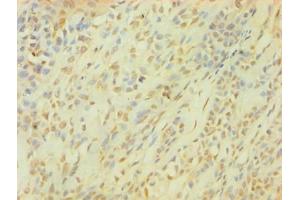 Immunohistochemistry of paraffin-embedded human breast cancer using ABIN7153564 at dilution of 1:100 (SNCG 抗体  (AA 1-127))