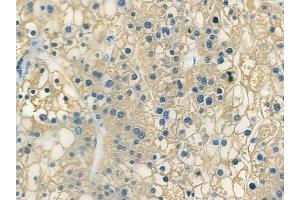 ABIN6266367 and ABIN6273361 at 1/100 staining human hepatocellular carcinoma by IHC-P.