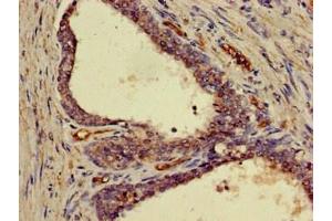 Immunohistochemistry of paraffin-embedded human prostate cancer using ABIN7152845 at dilution of 1:100 (FRS2 抗体  (AA 116-387))