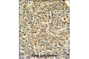 Merlin Antibody (N-term) (ABIN390756 and ABIN2841014) IHC analysis in formalin fixed and paraffin embedded human lung carcinoma followed by peroxidase conjugation of the secondary antibody and DAB staining.