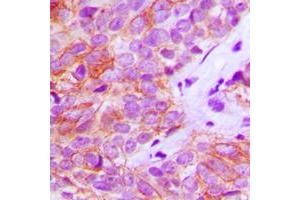 Immunohistochemical analysis of FGFR3 staining in human breast cancer formalin fixed paraffin embedded tissue section. (FGFR3 抗体  (Center))