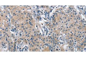 Immunohistochemistry of paraffin-embedded Human gastric cancer using TRIP4 Polyclonal Antibody at dilution of 1:50 (TRIP4 抗体)