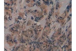 IHC-P analysis of Human Breast cancer Tissue, with DAB staining. (Fibrillin 2 抗体  (AA 1550-1791))