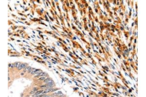 The image on the left is immunohistochemistry of paraffin-embedded Human colon cancer tissue using ABIN7192466(SLC2A5 Antibody) at dilution 1/12, on the right is treated with synthetic peptide. (SLC2A5 抗体)