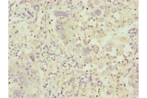 Immunohistochemistry of paraffin-embedded human liver cancer using ABIN7148371 at dilution of 1:100 (C8B 抗体  (AA 55-350))