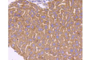 Paraformaldehyde-fixed, paraffin embedded human lung cancer, Antigen retrieval by boiling in sodium citrate buffer (pH6) for 15min, Block endogenous peroxidase by 3% hydrogen peroxide for 30 minutes, Blocking buffer at 37°C for 20min, Antibody incubation with Smad3 (3D1) Monoclonal Antibody  at 1:50 overnight at 4°C, followed by a conjugated secondary and DAB staining. (SMAD3 抗体)
