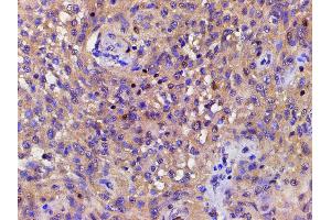 ABIN6267443 at 1/200 staining human meningeal carcinomatosis(MC) tissue sections by IHC-P. (Cofilin 抗体  (pSer3))