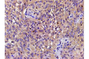 ABIN6267443 at 1/200 staining human meningeal carcinomatosis(MC) tissue sections by IHC-P. (Cofilin 抗体  (pSer3))
