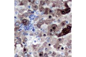 Immunohistochemical analysis of Geminin staining in human liver cancer formalin fixed paraffin embedded tissue section. (Geminin 抗体)