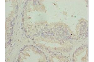 Immunohistochemistry of paraffin-embedded human prostate cancer using ABIN7167729 at dilution of 1:100 (RFPL2 抗体  (AA 99-378))