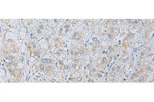 Immunohistochemistry of paraffin-embedded Human liver cancer tissue using NAGK Polyclonal Antibody at dilution of 1:35(x200) (NAGK 抗体)